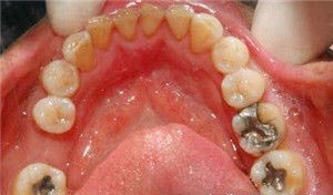 如何预防牙髓炎