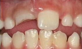 牙外伤导致牙脱落怎么办