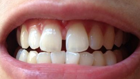 怎么预防儿童的牙齿稀疏