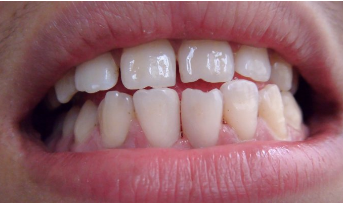 如何预防牙齿稀疏